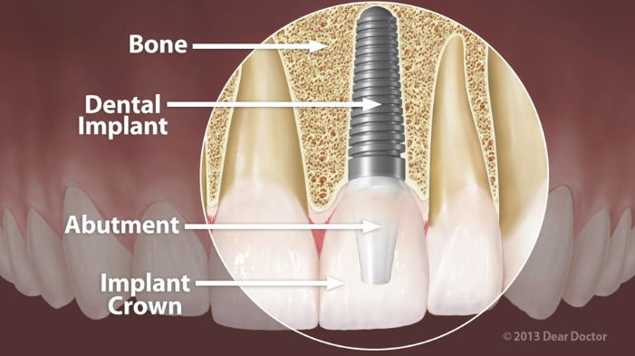Image of dental implants near Anniston, AL